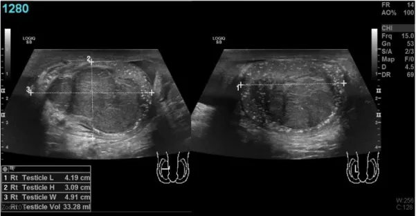 1. ábra Microlithiasis talaján kialakult, előrehaladott intratesticularis térfoglaló folyamat képe egy 55 éves férfi betegben