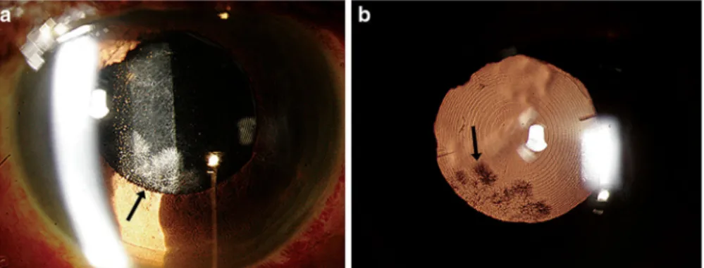 Fig. 1 Slit lamp biomicroscopy (a) with retro illumination (b) showing the fungal colonies on the posterior surface of the intraocular lens