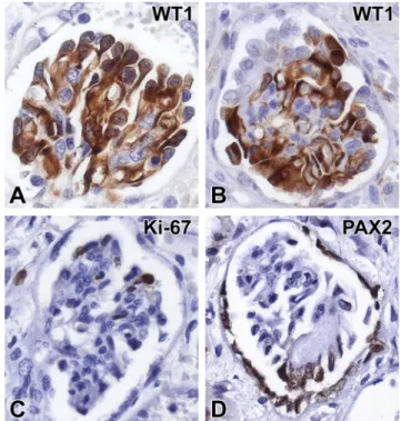 Fig. 2 Histological features of the glomeruli, tubuli, and interstitium in PDSS2 mutation