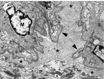 Fig. 4 Portion of a solidified glomerular segment observed using electron microscopy. Several layers of basement membrane material (asterisks) were deposited between the lamina densa of the glomerular basement membrane (arrowhead) and the hypertrophied pod