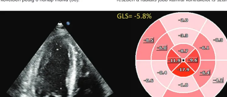 8. ÁBRA. Súlyos, kevert humorális és celluláris rejekció szívtranszplantáció után. Az ejekciós frakció csak enyhe-közepes  fokban csökkent (45%), azonban a longitudinális deformáció jelentősen károsodott az apikális szegmensek relatív megtartott  rövidülés