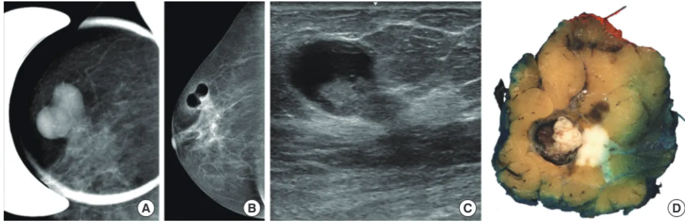 Figure 2. Histological characteristics and immunoprofile. (A) An intracystic papillary component (right) is surrounded by a thick fibrous capsule and an  invasive carcinoma (left) component on the low-power view of the lesion (H&amp;E stain, ×1.2)
