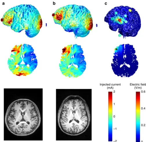 Fig. 5 Individualized models of transcranial electrical stimulation for two subjects with variable electrode placements