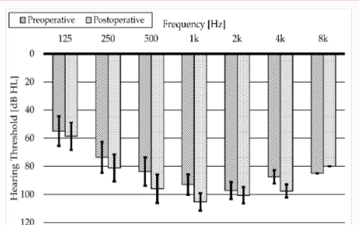 Figure  5:  Loss  of  acoustic  sensitivity  interpreted  in  dBHL  ranges,  while  exhibiting  the  number  of  implantees  frequency-specifically  (with  different  patterns of columns).