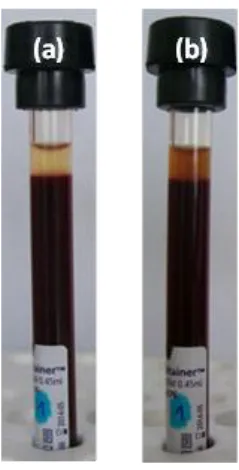 Figure 7. Sedimentation test results of sample from Donor #1: (a) vial contains original blood sample  and (b) vial the sample with P(PEGMA-AA)@MNP added at 0.24 mg/mL concentration