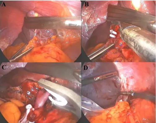 Figure 1. Steps in the laparoscopic splenectomy: (A) Exploration of the splenic hilum, (B) clipping of the splenic artery, (C) clipping of the splenic vein, and (D) removal of the specimen in a specimen retrieval container.