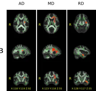 Fig 1. Significant group differences (p &lt; 0.05, corrected) in the white matter revealed by tract-based spatial statistics