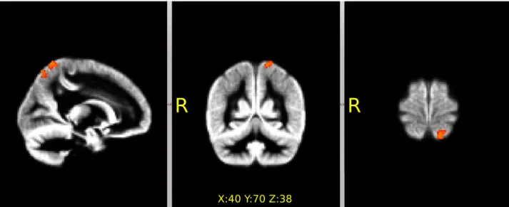Fig 2. Focal decrease of the gray matter density in the Parkinson’s patients revealed by voxel-based-morphometry