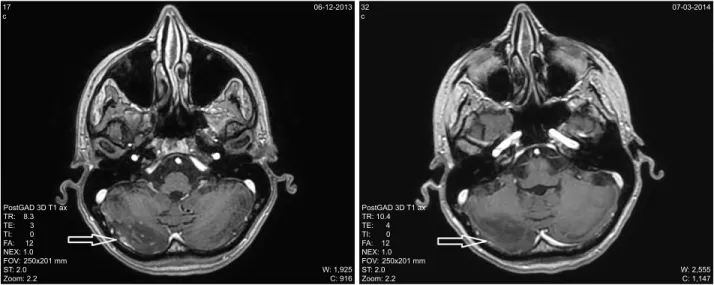 Figure 2 Brain metastases before and 3 months after the introduction of fulvestrant therapy (Case 2).