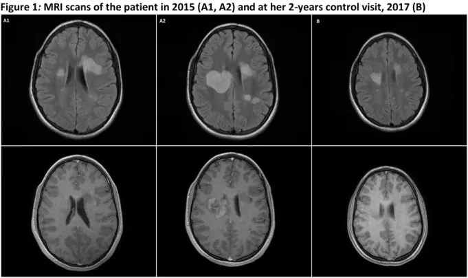 Figure 1: MRI scans of the patient in 2015 (A1, A2) and at her 2-years control visit, 2017 (B) 