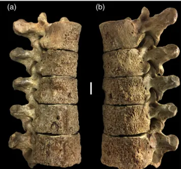 TABLE 1 Registered bony changes in the three specimens described in detail by anatomical regions (+ = present, − = not present)