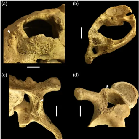 FIGURE 5 Superficial vertebral changes: (a) slight cortical remodelling and small, horizontal abnormal blood vessel impressions on the anterior aspect of T6; and erosive lesions accompanied by reactive new bone formation on the (b) left lamina and spinous 