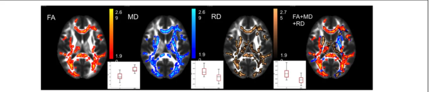 FIGURE 1 | White matter abnormalities in MwA compared to controls. Axial slices show the diffusivity parameter changes from TBSS