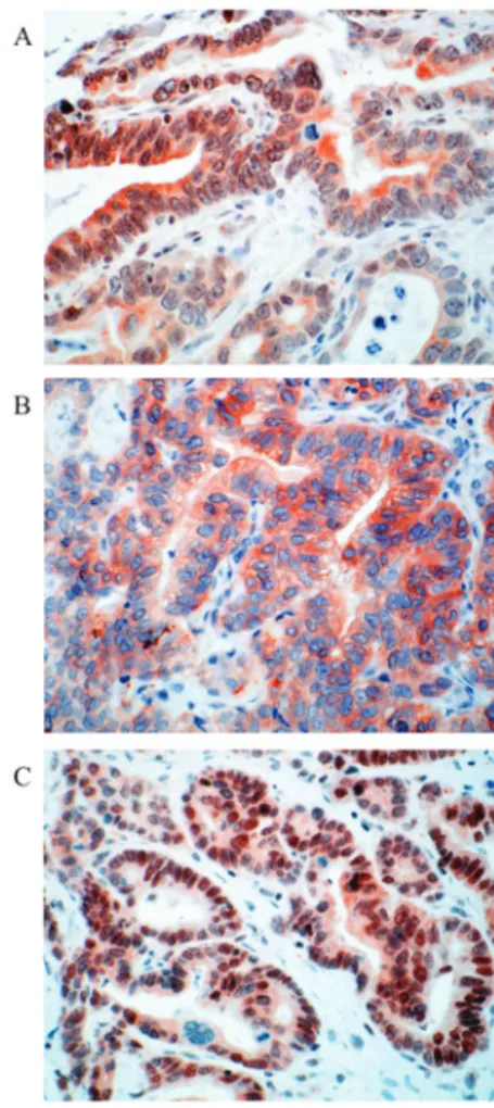Figure 6. Representative examples of  β -catenin expression in colorectal  liver metastasis