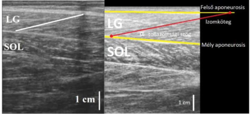 5. ábra. Ultrahang felvétel a laterális gastrocnemiusról (LG) 