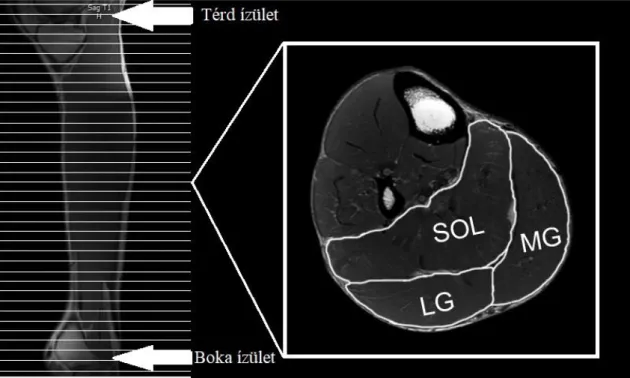 6. ábra. Egy vizsgálati személy lábszáráról készült MRI felvétel 