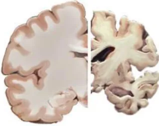 2. ábra. Az egészséges agy és az Alzheimer-kóros agy összehasonlító szemléltetése. 