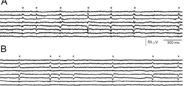 Figure 6. Example recording of SPA from an epileptic (A), and from a tumor (B) patient