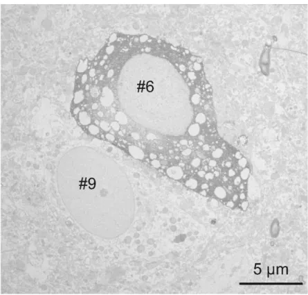 Figure 5. The electron microscopic investigation of the same cell (Figure 18, 28 #6) showed large empty spaces (vacuoles) in  the cell body