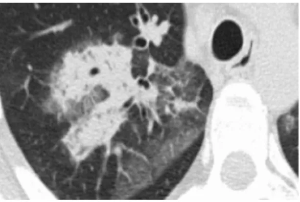Figure 4: Broncho-alveolar cell carcinoma with ground-glass opacity and consolidation 