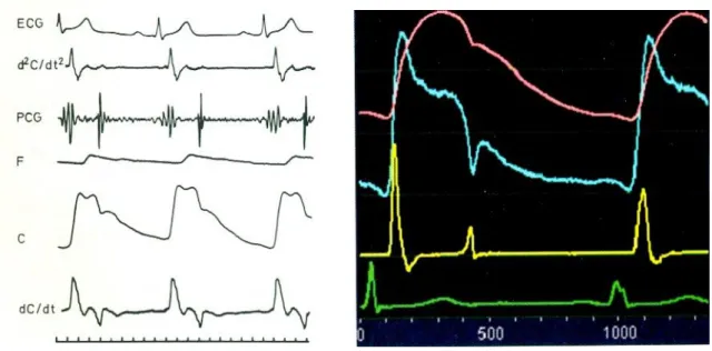 2. ábra. Mechanokardiográfiás és echokardiográfiás carotis felvételek. Az ábra bal  oldalán  a  carotis  pulzushullám  mechanokardiográfiás  felvétele,  annak  első  és  második  idő  szerinti  deriváltja,  (dC/dt,  d²C/dt²)