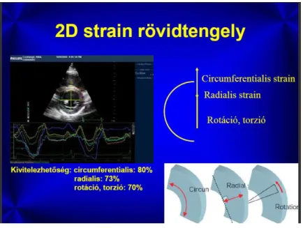 5. ábra. 2 D strain rövidtengelyű echokardiográfiás felvételen történő ábrázolása, a  cirkumferenciális  és  radialis  strain,  valamint  a  rotáció,  torzió  sematikus  szemléltetésével (dr