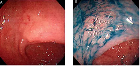 2. ábra. Lapos gyomorpolip (korai karcinóma) a rutin endoszkópia (A)  és a kromoendoszkópia során (B)