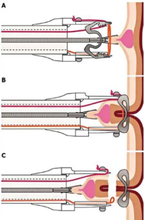 7. ábra. Endoscopic full thickness resection. 