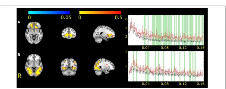 FIGURE 2 | The two white matter functional networks showing differences between MWA and healthy volunteers (IC2, A and IC17, B)