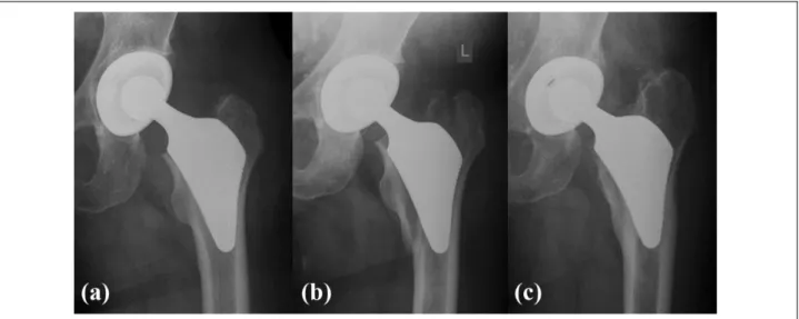 Figure 2. (a) Two years after THR subsidence and osteolysis are visible around the Proxima stem in a 50-year-old male patient.