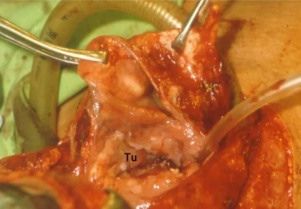 Figure 1.  Extended (T3-T4) tumor from piriform  sinus. Tu: Hypopharyngeal tumor.