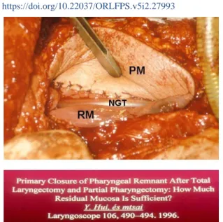 Figure 3. Replacement of pharyngeal wall-, and skin defect with  PM gemini flap. 
