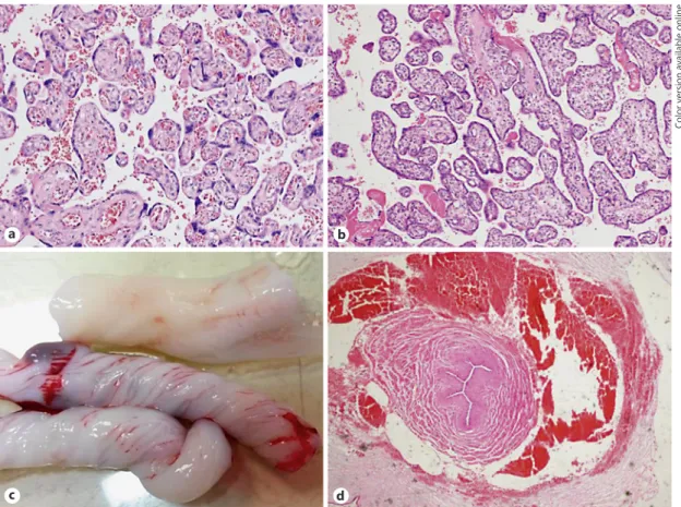 Fig. 2.  Placental and umbilical cord histopathology; normal pla- pla-cental tissue ( a ) with vascularized villi and intrauterine  growth-restricted placental tissue ( b ) with hypovascularization and  inter-villous fibrin deposition (HE, 200×)