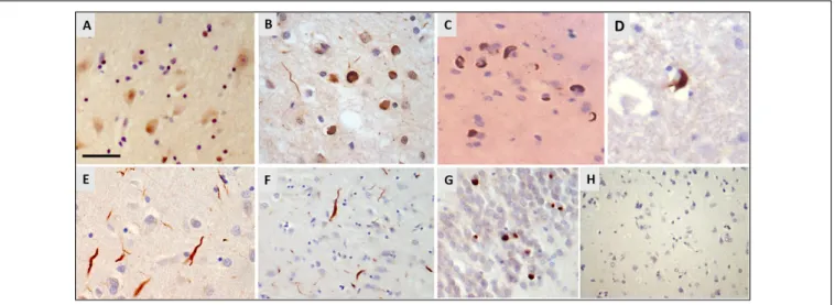 FIGURE 1 | Immunohistochemistry for hnRNP E2. (A) Weak cytoplasmic staining and stronger nuclear staining is seen in the frontal cortex of a control case (case ID BBN_16256)