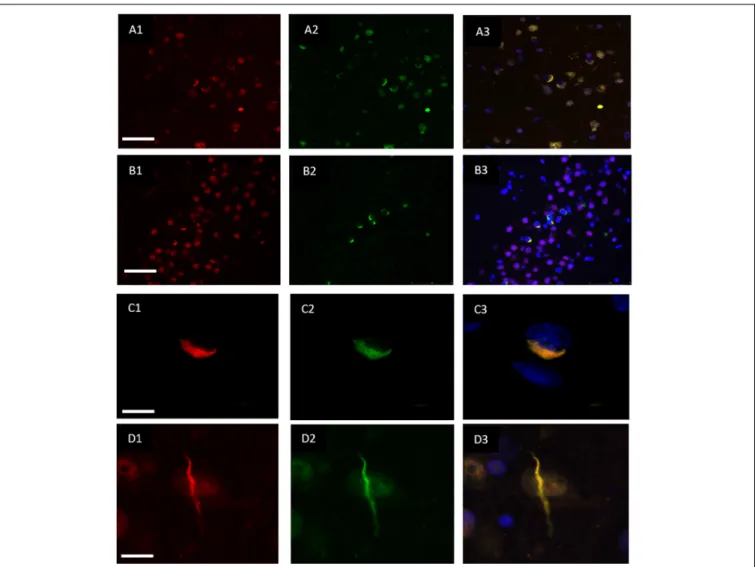 FIGURE 2 | Co-localisation of TDP-43 and hnRNP E2. Double-labeling immunofluorescence shows inclusions positive for TDP-43 (red) (A1) and hnRNP E2 (green) (A2) in the frontal cortex of a subtype A case, the merged image (A3) shows numerous areas of co-loca