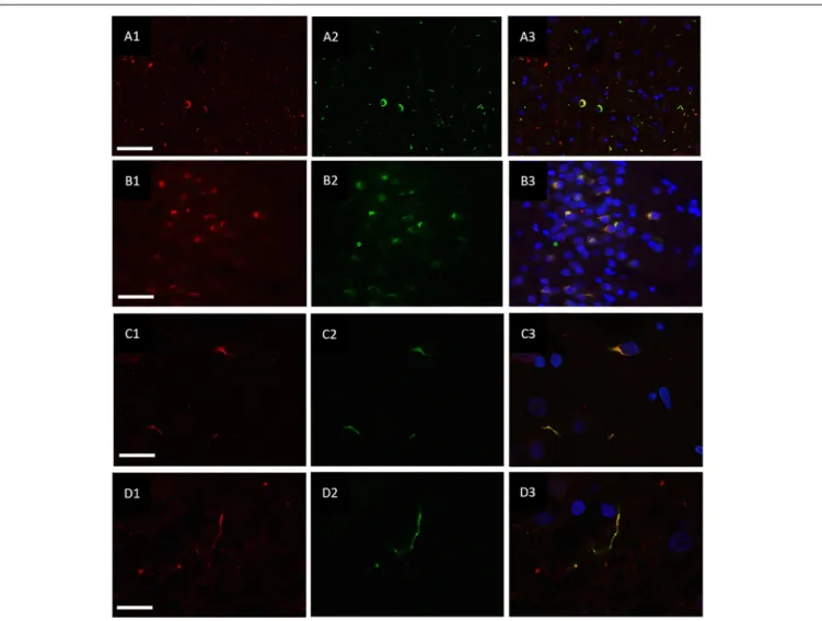 FIGURE 3 | Co-localisation of ubiquitin and hnRNP E2. Double-labeling immunofluorescence of Ubiquitin (red) and hnRNP E2 (green) shows high levels of co-localisation within the frontal cortex (A1–A3) and hippocampus (B1–B3) of a subtype A case (case ID BBN