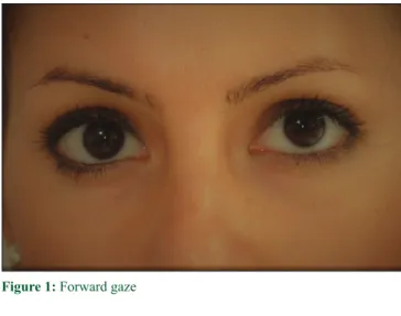 Figure 1: Forward gaze
