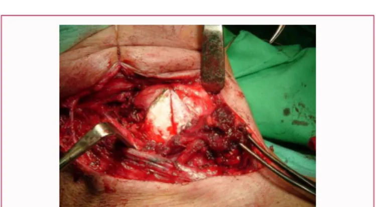 Figure  5: Neck dissection and tracheotomy from unilateral incision, lateral  pharyngotomy, exploration of larynx (thyroid cartilage).