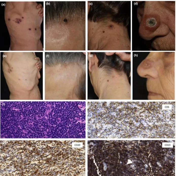 Figure 1 Patient 1 with chronic lymphocytic leukaemia. (a – c) Necrotic papules in a zosteriform arrangement on (a) the right side of the chest wall, (b) nape of the neck, (c) and forehead; (d) morphologically different lesion on the tip of the nose, which