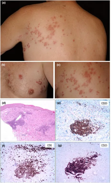 Figure 2 Patient 2 with chronic lymphocytic leukaemia. (a – c) Infiltrated papules localized to the left thoracic area (Th1/2 dermatomes).