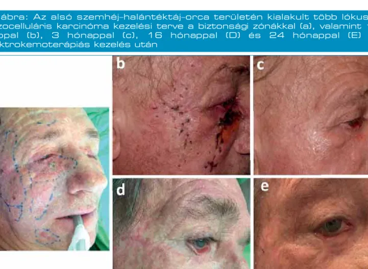 2. ábra: A jobb alsó szemhéjon és orrszárnyon rekurrensen kialakult bazo  - -celluláris karcinóma a kezelés előtt (a) és 12 hónappal egy elektroke  mo  -terápiás kezelést követően (b)