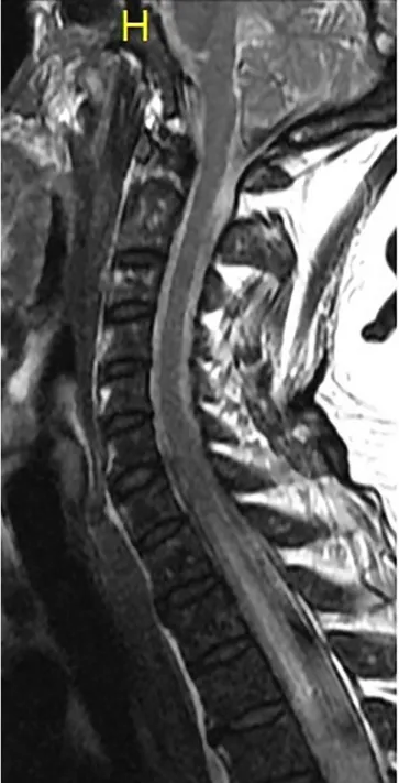 Fig. 2. MRI of the cervical and upper thoracic spine showing T2 hyperintense lesion in the spinal cord below the 7th cervical segment.