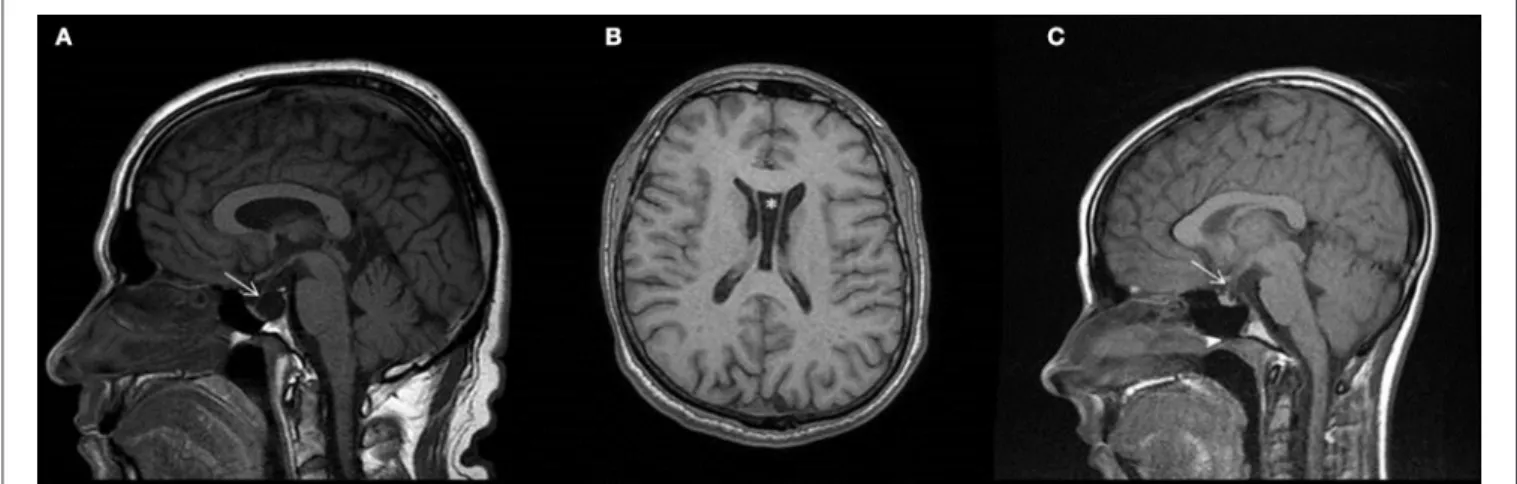 FIGURE 2 | Brain MR images of the examined patients. T1 weighted images of Patient II/2 (A,B), and of Patient III/1 (C)