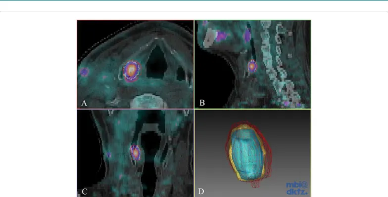 Figure 3: Intermodality differences of gross tumour volume delineation. Axial (A), sagittal (B) and coronal slices (C) of fused  18 F-FDG PET/CT images and 3D Gaussian  filtered contours (D) of a head and neck cancer patient (hypopharynx)
