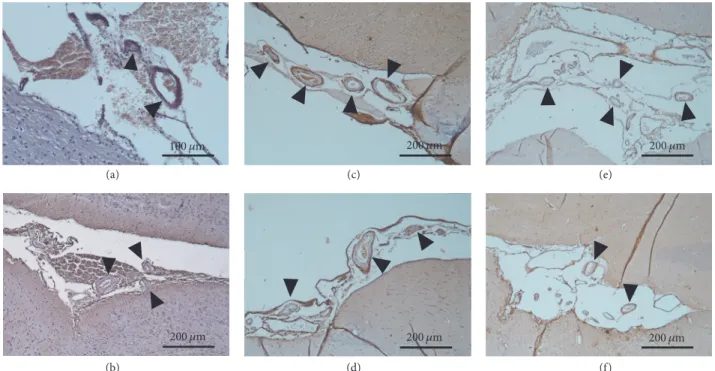 Figure 7: Cerebral amyloid angiopathy represented by immunohistochemistry (100x magnification)