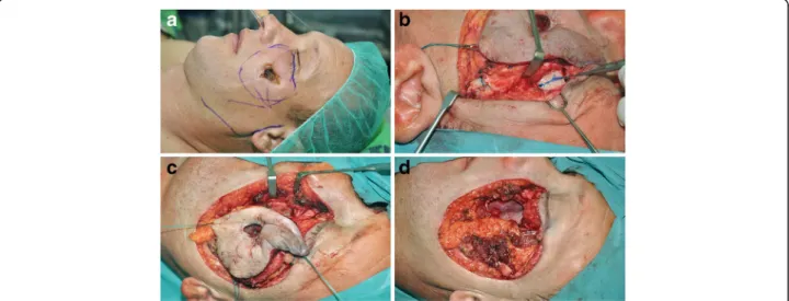 Fig. 1 Preoperative appearance of the basal cell carcinoma in the left midface (a) and the radical tumor resection procedure (b-d)