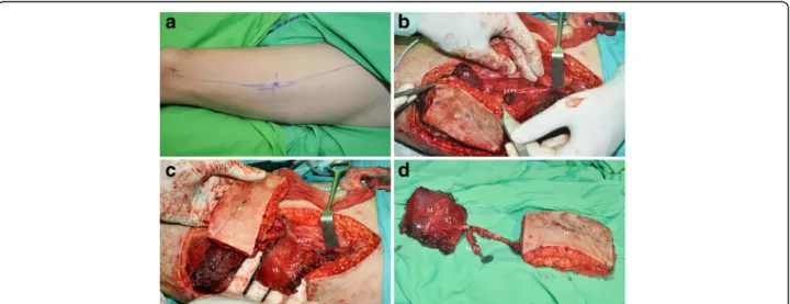 Fig. 3 Marking of the surgical site and the perforator vessel on the left thigh (a). Raising of the chimeric type I anterolateral fasciocutaneous (FC) and vastus lateralis muscle segment (VL) flap with the circumflex femoral vessels (LCFV) (b, c), and the 