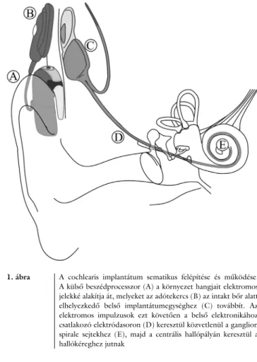 1. ábra A cochlearis implantátum sematikus felépítése és működése. 