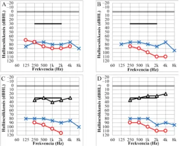 5. ábra Pre- és posztoperatív tisztahang-küszöbaudiometriai eredmé- eredmé-nyek. Az implantációt a jobb fülön végeztük el (piros görbék); 