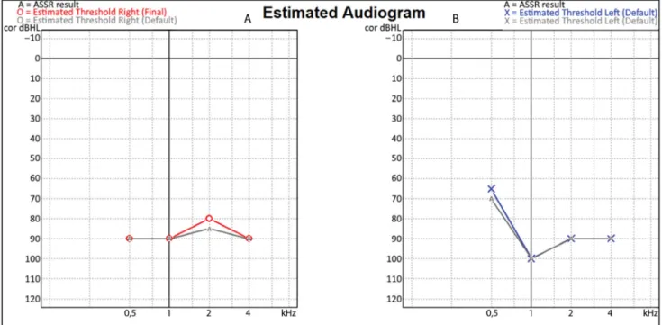 6. ábra Preoperatív objektív hallásküszöbértékek jobb és bal oldalon. Auditoros steady-state válaszok (ASSRs) vizsgálata során az objektív hallásküszöböt,  ezzel a residualis hallást mindkét oldalon nagy-súlyos fokban emelkedettnek mértük